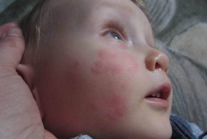 Виды аллергии у детей таблица и фото