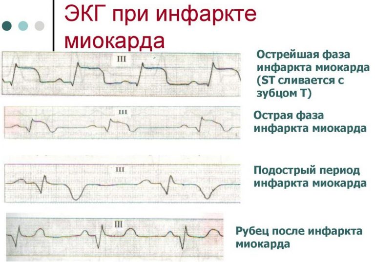 Прочитать кардиограмму онлайн по фото