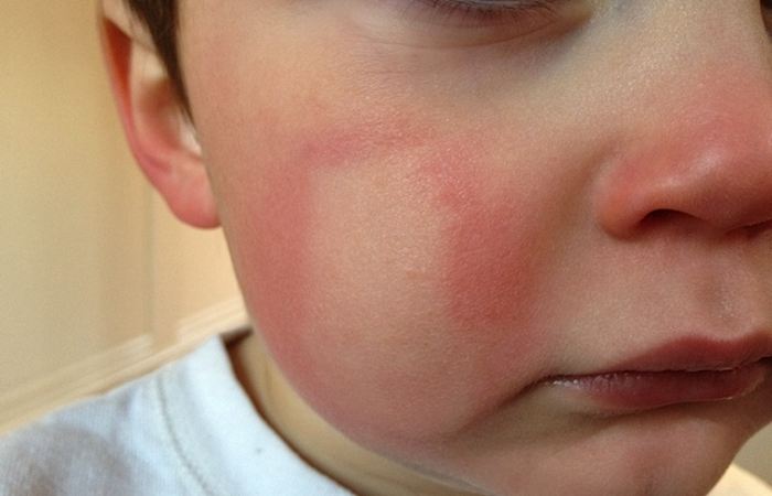 Контактный дерматит у ребенка на лице фото