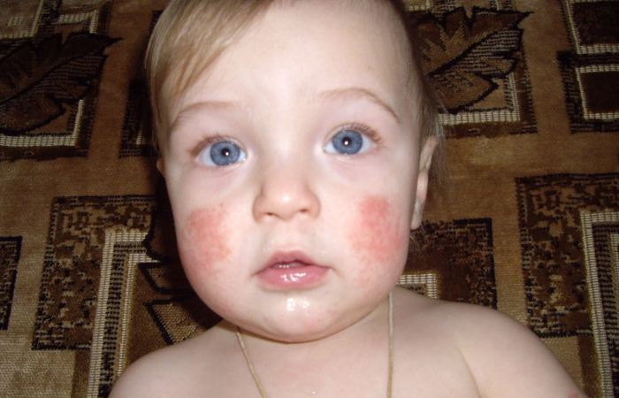 Аллергия на витамин Д у ребенка