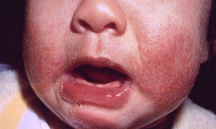 Аллергия на коже от молока фото thumbnail