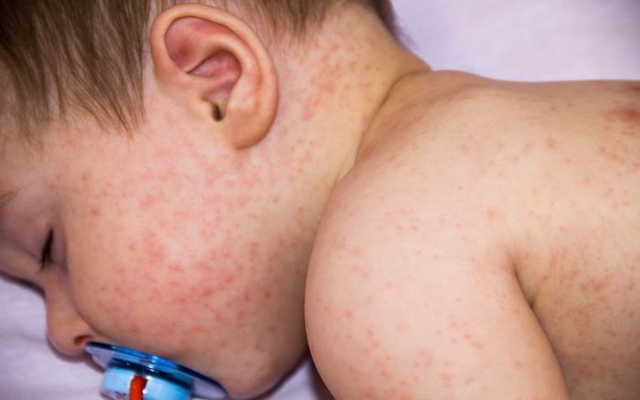 Аллергия на сладкое у ребенка