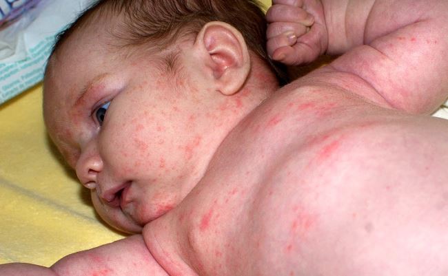 Аллергия на смесь у ребенка