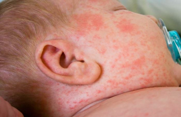 Аллергия на сладкое на лице у детей фото thumbnail