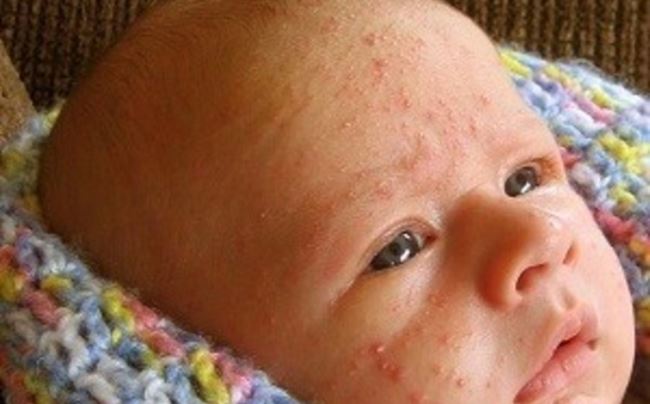 Сыпь при аллергии у детей фото на смесь thumbnail