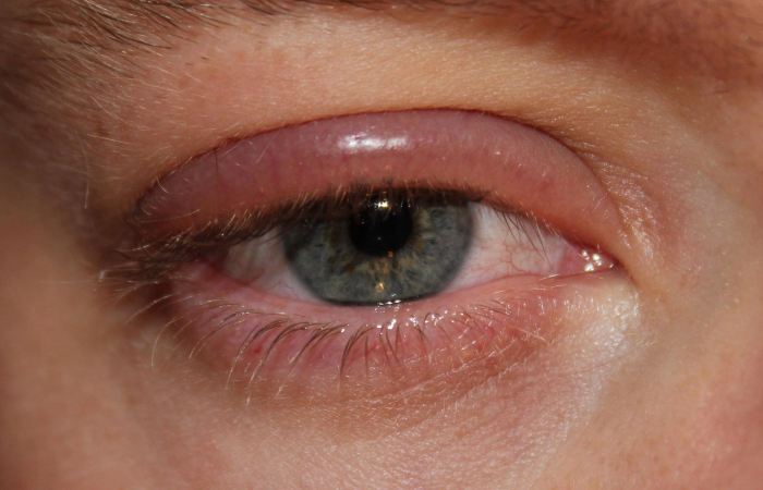 Аллергия глаз отек фото thumbnail