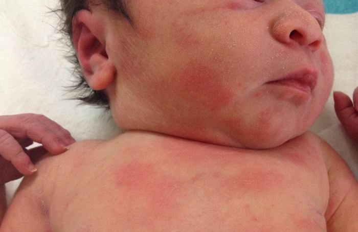 Пищевая аллергия у новорожденных
