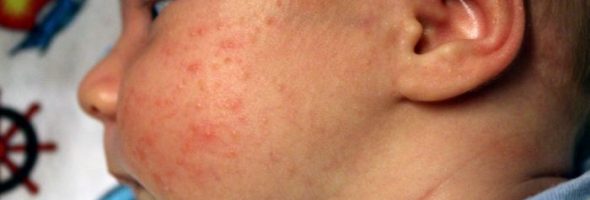 Сыпь при аллергии у грудничка фото