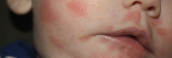 Аллергия на молоко