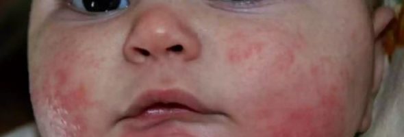 Аллергия на сладкое