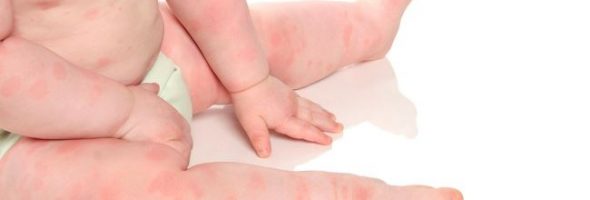 Аллергия на смесь