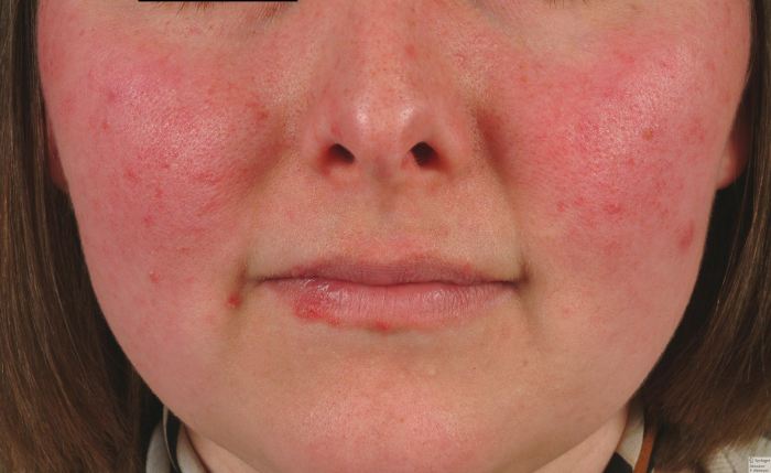 Как может проявляться аллергия на лице фото