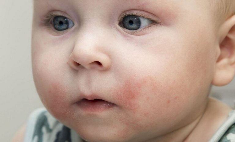 Аллергия на еду у детей фото
