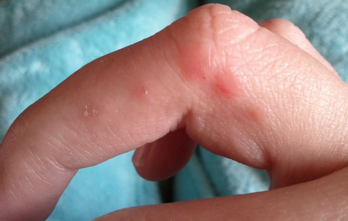 Аллергия на порошок на лице у ребенка thumbnail