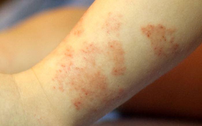 Фотографии аллергии на стиральный порошок thumbnail