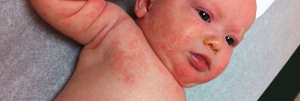 Аллергия на глютен и коровий белок