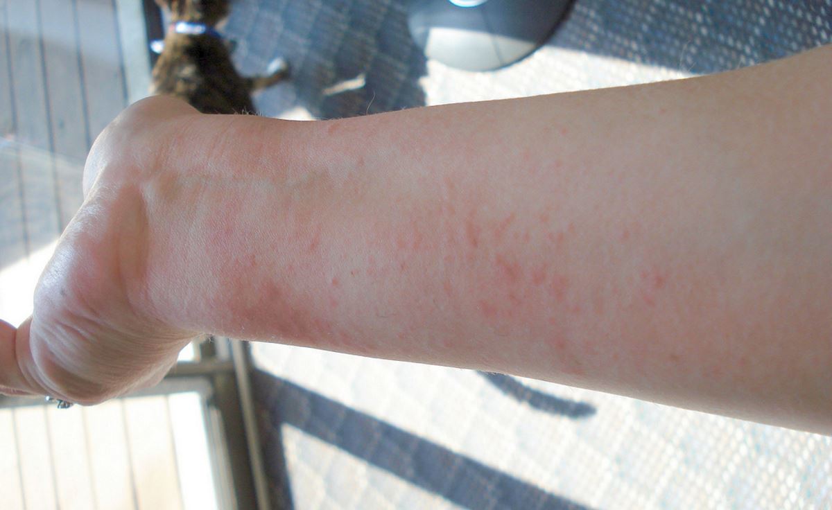 Как проявляется аллергия на порошок фото