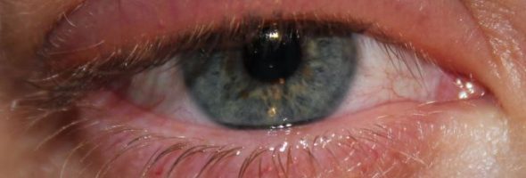 Аллергия на тушь, хну и солярий