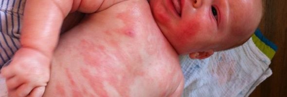 Аллергия на продукты