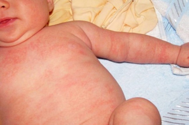 Аллергия на ромашку у ребенка