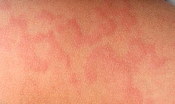 Аллергия на семечки подсолнуха