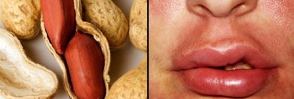 Аллергия на бобы, орехи и крупы