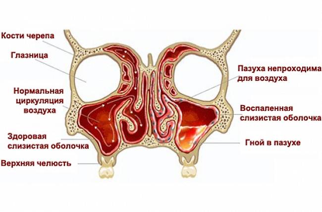 Гайморит