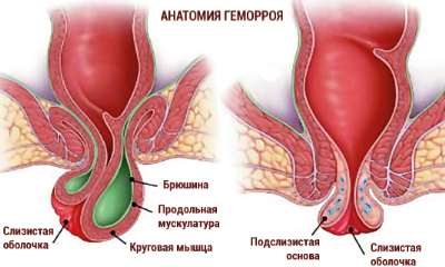 Как выглядит геморрой