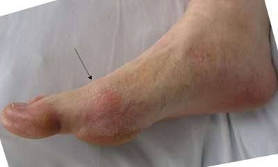 Болезнь подагра на ноге симптомы фото thumbnail