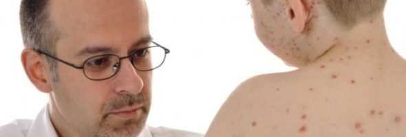 Начальная стадия ветрянки