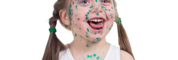 Ветрянка у детей