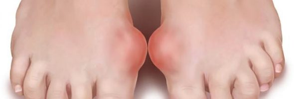 Симптомы и признаки подагры