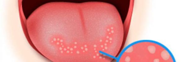 Как выглядит стоматит