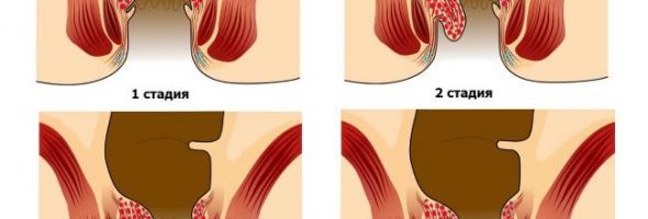 Начальная стадия геморроя