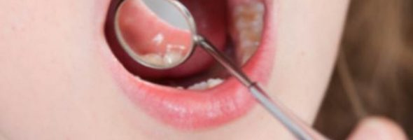 Что такое стоматит