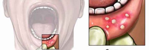 Стоматит у взрослых