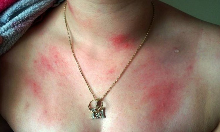 Аллергия на детский шампунь фото thumbnail