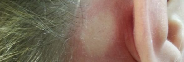 Как выглядит аллергия на косметику