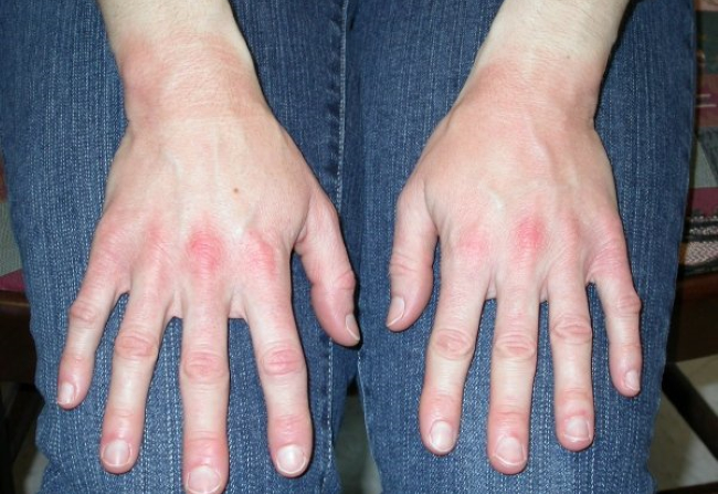 Аллергия на резиновые перчатки