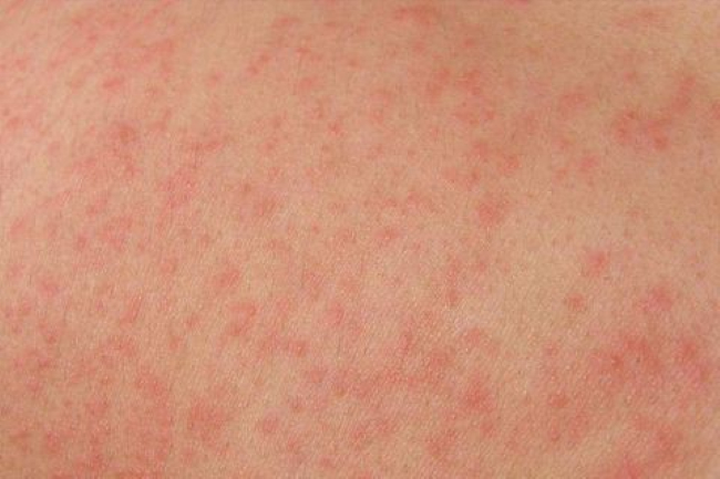 Аллергия на синтетику и шерсть thumbnail
