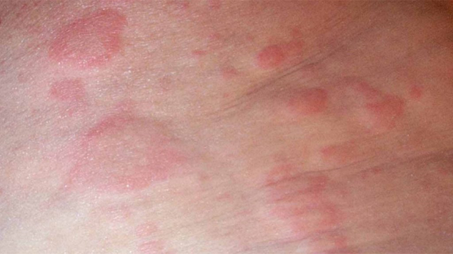 Аллергия на шерсть