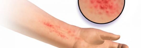 Как выглядит контактный дерматит