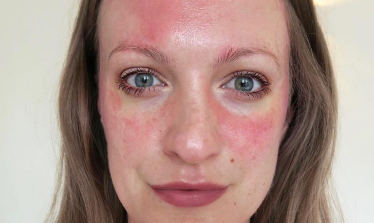 Аллергия на лице фото у взрослых чем лечить