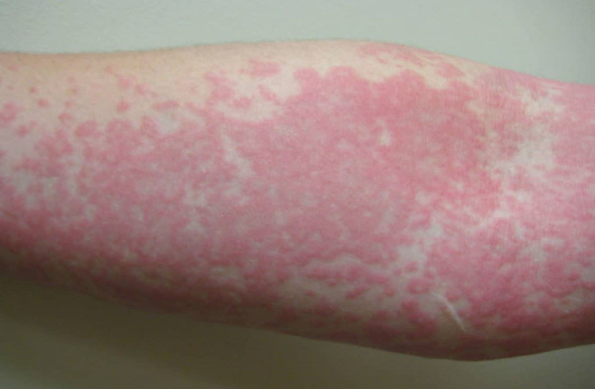 Аллергия на руках от нервов фото