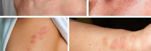 Как выглядит аллергия у взрослых