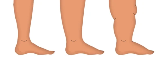 Как выглядит лимфостаз